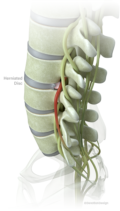 Sciatic Nerve