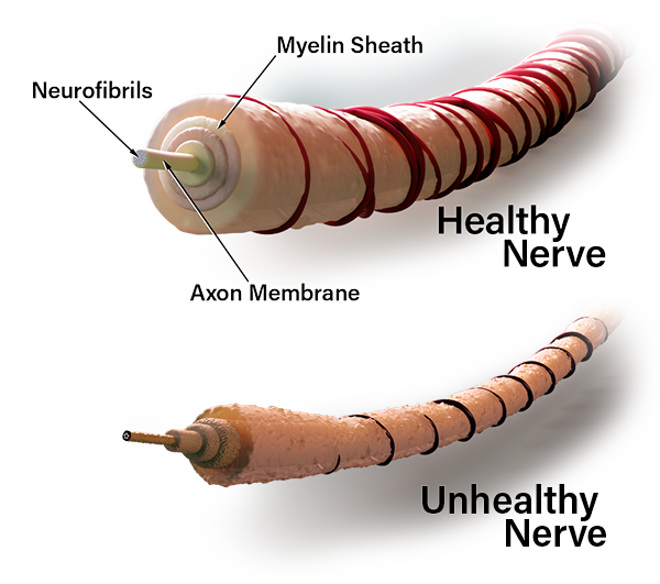 Nerve Damage Progression